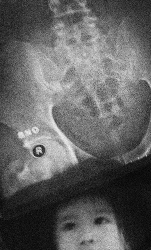 Melihat hasil rontgen